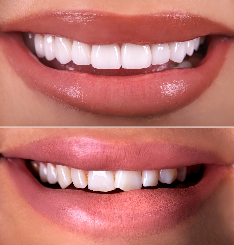 Benefits of Restorative Dentistry west meade dental in nashville TN before and after restorative dentistry treatment
